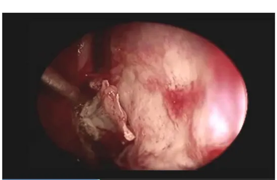Figure 9 : Repérage du rostre vomérien, décollement de la muqueuse nasale de son insertion au  niveau du rsotre vomérien 