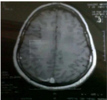 Fig. 10 : Séquence en T1 montrant des hyper signaux correspondant aux thrombus au niveau du  SLS et SL droit chez une femme de 29 ans présentant un Syndrome d’HTIC 