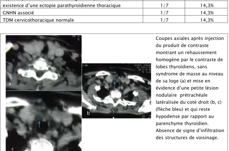 Tableau n°6: Tableau récapitulatif des résultats de la TDM cervicothoracique  chez nos patients 