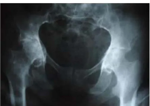 Figure 9 :  Rx de la hanche face chez une patiente âgée de 38 ans   qui présente une coxite bilatérale sur PR