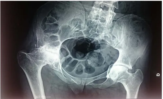 Figure 11 :  Rx de bassin face chez un sujet de 40ans   ayant présenté une coxarthrose secondaire à une SPA