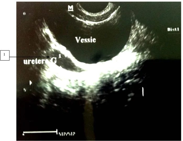 Figure 6: Echographie montrant une dilatation urétérale en amont de la jonction urétéro- urétéro-vésicale (1) chez un patient dans notre série