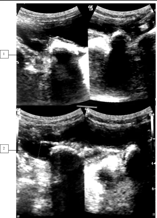 Figure 7: Echographie montrant une lithiase urétérale  (1, 2) chez une patiente de  notre série
