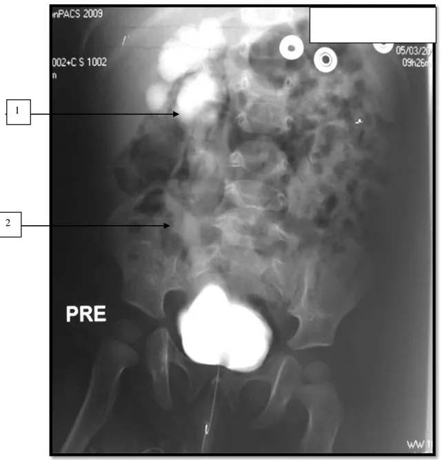 Figure 10: Cystographie montrant un RVU grade VI  unilatéral chez un cas :  1 : dilatation pyélocalicielles très importante.