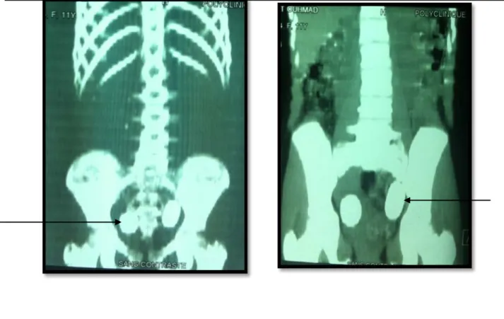 Figure 15: Coupes scannographiques et  de reconstruction montrant une lithiase urétérale  bilatérale  chez un cas dans notre série (voir les flèches)