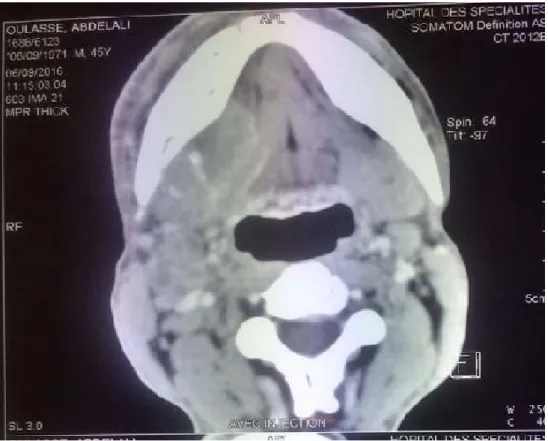 Figure 18: TDM cervico-faciale en coupe axiale montrant un processus  tissulaire de la glande sous maxillaire droite d’allure suspect