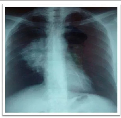 Figure 12 : radiographie thoracique de face montrant une opacité para hilaire droite 