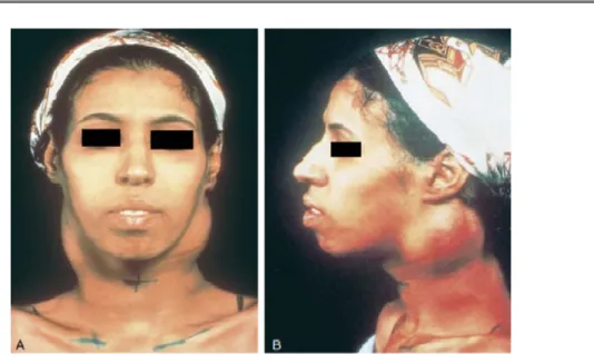 Figure 6 : ADPS cervicales chez une femme atteinte de lymphome hodgkinien 