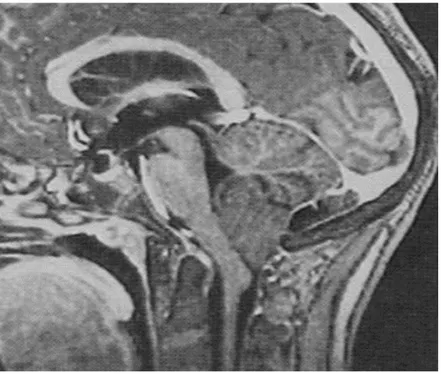 Figure 15: IRM cérébrale, séquence T1 coupe sagittale montrant une Chiari II avec hernie des  amygdales cérébelleuses  dans le canal cervical (Service de radiologie CHU Med VI ) 