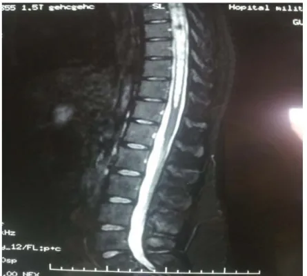 Figure 17 : Coupe sagittale d’une IRM médullaire montrant une syringomyélie dorsale 