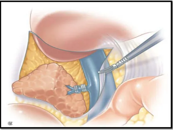 Figure 2: ligature première de la veine surrénalienne principale,   puis dissection médiale de la surrénale droite [198]