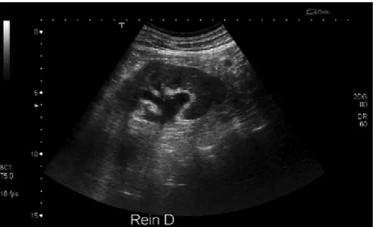 Figure 23: Échographie rénale : dilatation des cavités pyélocalicielles droites lors d'une CN.[66]  Au total, L'échographie utilisée seule a une sensibilité de 10 à 50 % selon les séries et a  donc un intérêt limité pour la mise en évidence des calculs : d