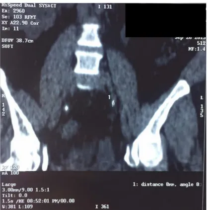 Figure 36 :  uroscanner en reconstruction 2D  coupe frontale , montrant deux  calculs bilatéraux   de l’uretère iliaque mesurant respectivement 13 mm à droite  et 11 mm  à  gauche