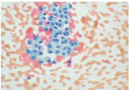 Figure 8  : Une image de cytologie urinaire objectivant un carcinome  urothélial de bas grade (Photo de notre étude) 