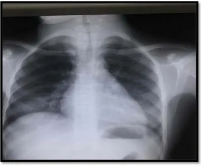 Figure 9 : Radiographie du thorax prenant le cou de face montrant un goitre compressif avec  refoulement de la trachée à gauche 