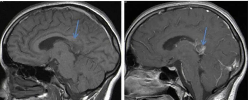 Figure 13 : IRM en séquence sagittale T1 avant et après injection de gadolium :  Rehaussement partiel 
