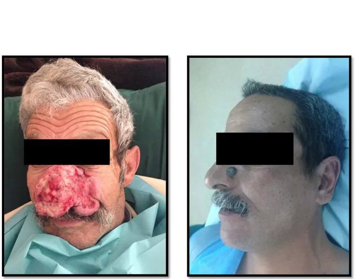 Figure 12 : Aspect ulcérobourgeonnant d’un  carcinome épidermoïde centrofacial  chez un patient âgé de 64 ans remontant 