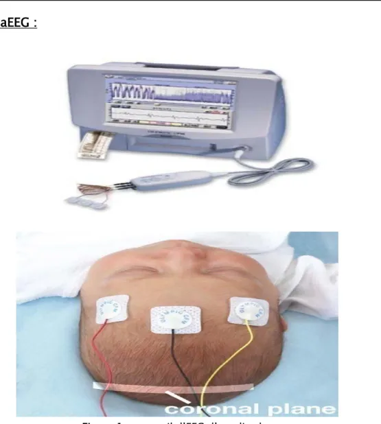 Figure 1 : appareil d’EEG d’amplitude.  Critères d’anomalies aEEG: 