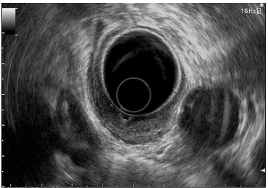 Figure 3 : Aspect écho-endoscopique d’une GIST rectale  2.5.  L’imagerie par résonnance magnétique : IRM :  