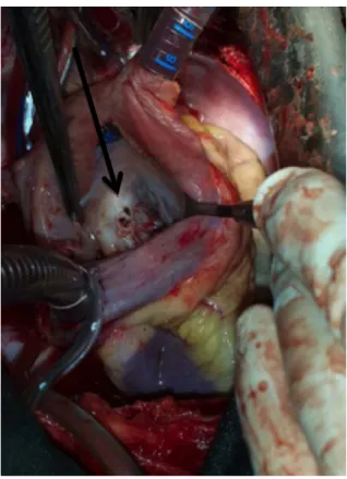 Figure 5 : Images de fistules aorto-atriales droites en peropératoire (CHU MED VI) 