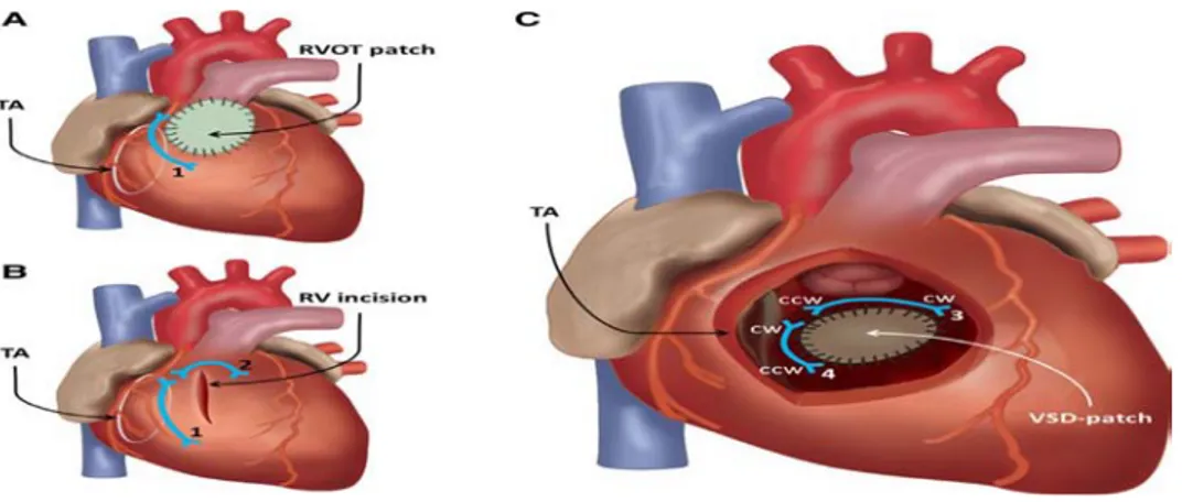 Figure 7 : Fermeture d’une CIV par patch par ventriculotomie [53]    2T Une correction de malformations locorégionales associées :  