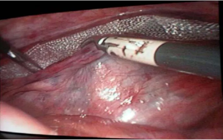 Figure 13: Mise en place d’une prothèse de Polypropylène lors d’un abord TAPP.  e.  Fixation de la prothèse : 