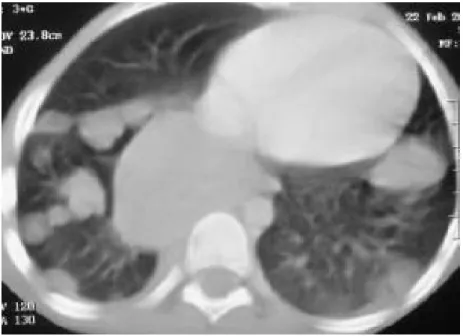 Figure 10: TDM thoracique révélant des métastases pulmonaires d’un néphroblastome 