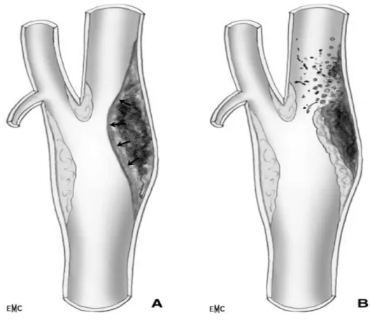 Figure 12 : Complications anatomiques au niveau de la plaque:  A-hémorragie B-ulcération [20] 
