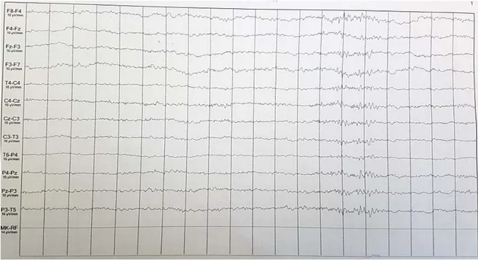 Figure 2: EEG de scalp du CAS N2 montrant des anomalies paroxystiques focalisées   en temporal gauche 