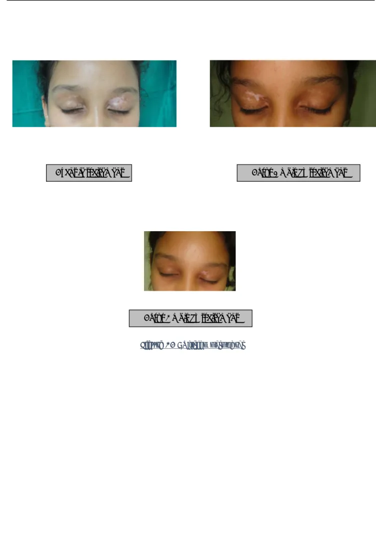 Figure 13 : Vitiligo palpébral 