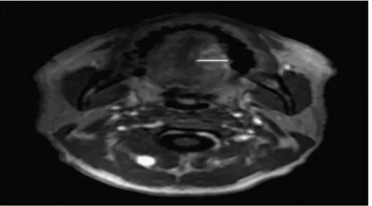 Figure 10 :  IRM en coupe axiale, séquence T1 avec injection de gadolinium : Tumeur de la 