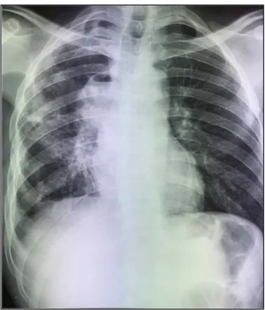 Figure 7 : Radiograhie de thorax face montrant une opacité médiastinale droite   en rapport avec un kyste hydatique 