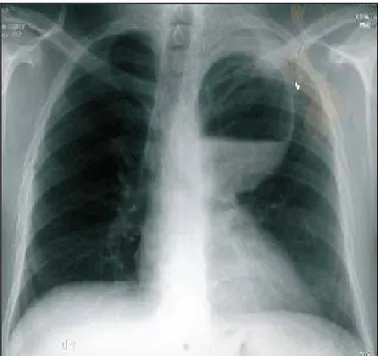 Figure 9 : Radiographie thoracique de face montrant un KHP du LSG avec niveau hydro-aérique 
