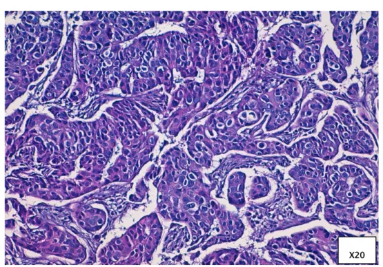 Figure 21 : Carcinome mammaire infiltarant de type non spécifique (coloration HE) service  d’anatomie pathologique, CHU Mohammed VI Marrakech 