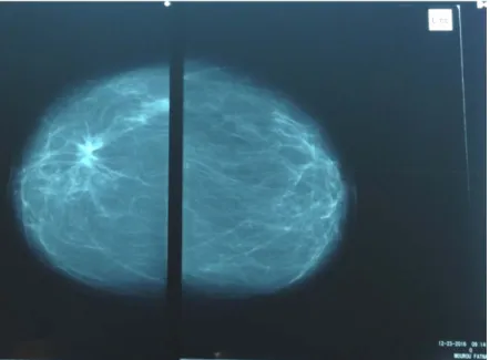 Figure 15 :  Mammographie: nodule du QSE du sein droit, suspect de malignité ACR 5 