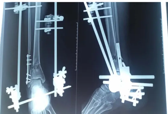 Figure 8 : Fracture du PT type A traitée par fixateur externe d’Hoffman en double jeux + plaque visée de la  fibula 