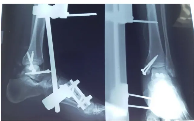 Figure 18 : Fixation externe (Hoffman un seul jeu) +vissage de la MI+vissage de l’astragale 