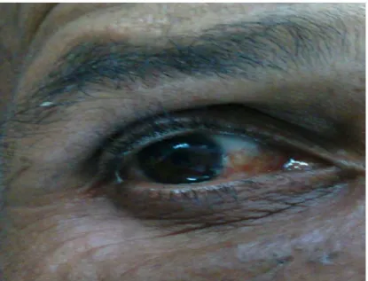 Figure 23 : Ptérygion nasal vascularisé débutant (stadeI)  de l’oeil droit.   Service d’ophtalmologie de l’HMA / MARRAKECH 