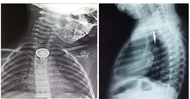 Figure 15 :  Radiographie thoracique (face et profil) montrant la présence d’un pendentif  métallique au niveau du tiers moyen de l’œsophage