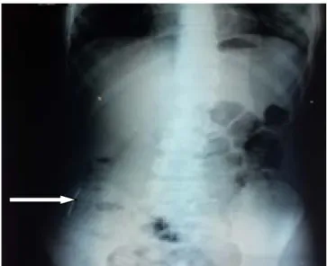 Figure 18 :  Radiographie abdominale montrant la présence d’une épingle au niveau intestinal