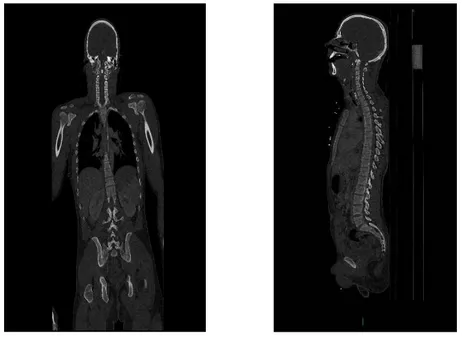 Figure 3 : scanner corps entier en reconstruction osseuses face et profil 