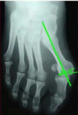 Figure 4 : Radiographie de face montrant l'angle AADM [14].  •  L'importance de l'exostose