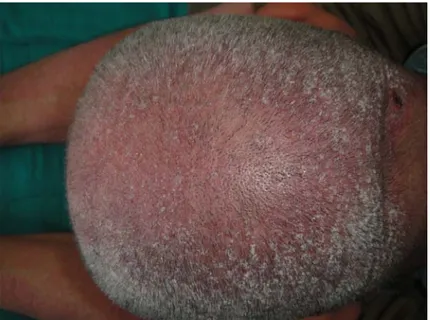 Figure 9B : Papules hyperkératosiques au niveau du scalp au cours d’une DM spinulosique 