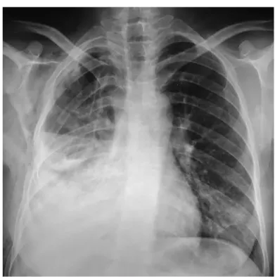 Figure 6 : Radiographie thoracique de face montrant un niveau hydroaérique  en rapport avec un pyopneumothorax