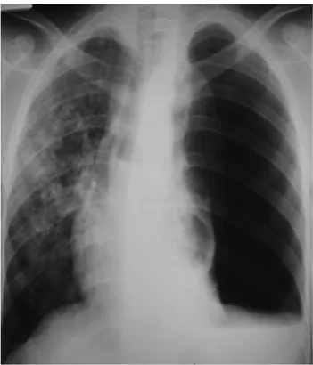 Figure 23 : Pyo-pneumothorax gauche associé à un infiltrat excavé controlatéral secondaire à  une tuberculose [32]