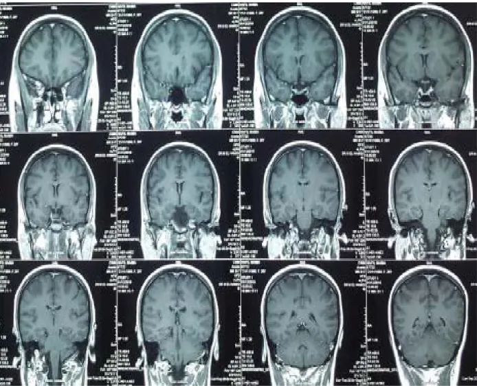 Figure n°8 : Coupes coronales d’une IRM cérébrale montrant un arachnoidocèle intrasellaire