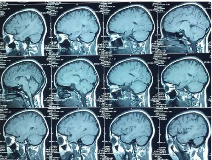 Figure n°9 : Coupes sagittales d’une IRM cérébrale montrant un arachnoidocele intra sellaire 