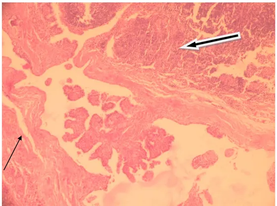 Figure 16: Microcarcinome papillaire sur thyroïdite lymphocytaire de Hashimoto.  Flèche fine : trainées lymphoplasmocytaires.,Flèche épaisse : follicules lymphoïdes