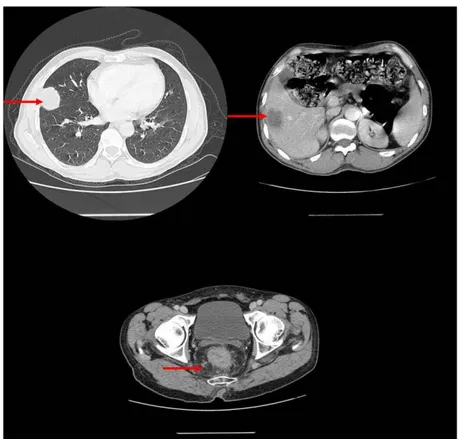 Figure 11 : TDM TAP montrant un cancer du rectum avec MH et pulmonaires chez un  patient de notre étude