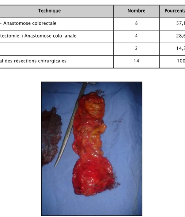 Tableau XIII : Les différents types de résection chirurgicale des cancers rectaux (n=14)